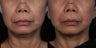 Ulthera Non surgical Facelift