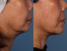 Ulthera Non surgical Facelift