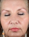Female After 1 ePrime™: The Evolastin™ Procedure