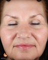 Female After 1 ePrime™: The Evolastin™ Procedure
