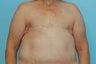Bilateral DIEP Flap Breast Reconstruction: Delayed