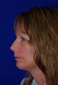 Chin Implant