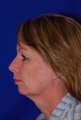 Chin Implant