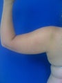 Laser Liposuction