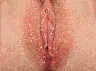 Vaginoplasty