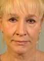 Woman gets a brighter look on life