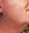 Vascular malformations or birthmarks