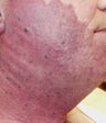 Vascular malformations or birthmarks