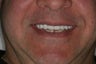 45 year old male treated with All-on-4 Dental Implant Procedure upper arch