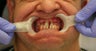 45 year old male treated with All-on-4 Dental Implant Procedure upper arch