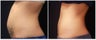 Coolsculpting