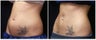 Coolsculpting