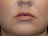 Before & After Lip Fillers