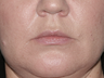 Before & After Lip Fillers