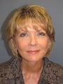 Liposuction, LiteLift™ on 58-year-old Woman