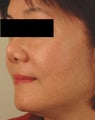 Sun Spot Removal for Asian Skin