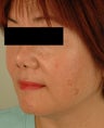 Sun Spot Removal for Asian Skin