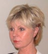 Band Aid "Mini" Facelift Results