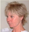 Band Aid "Mini" Facelift Results