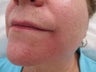66 year old female treated with Radiesse for Marionette Lines