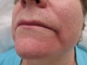 66 year old female treated with Radiesse for Marionette Lines