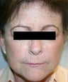 Ultherapy