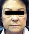 Ultherapy