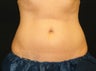 CoolSculpting