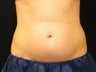 CoolSculpting