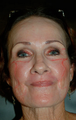 Laser Resurfacing