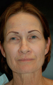 Laser Resurfacing
