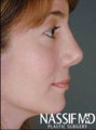 Female Revision Rhinoplasty
