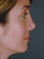 Female Revision Rhinoplasty