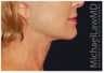 Facelift
