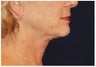 Facelift