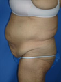 Circumferential Tuck
