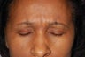 Female Treated with Botox