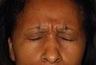 Female Treated with Botox