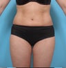 Liposuction