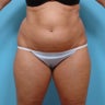 Liposuction