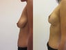 Breast Lift