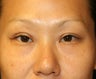 Asian Eyelid (double eyelid) Procedure