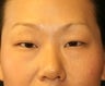 Asian Eyelid (double eyelid) Procedure