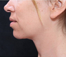 Chin Liposuction