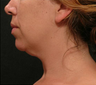 Chin Liposuction