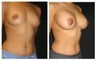 Breast Implants