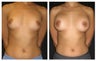 Breast Implants