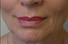 Lip Lift