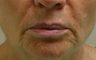 Lip Lift