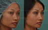 Revision Asian Rhinoplasty